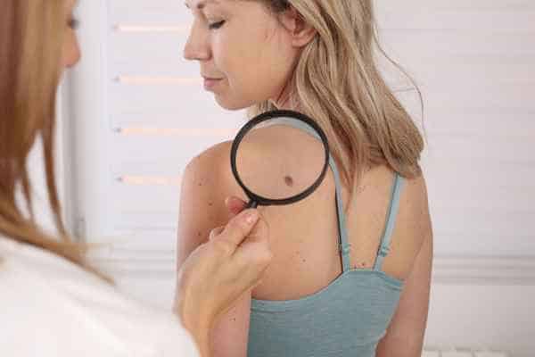 What Are Traditional Skin Lesion Removal Methods Lincolnshire?