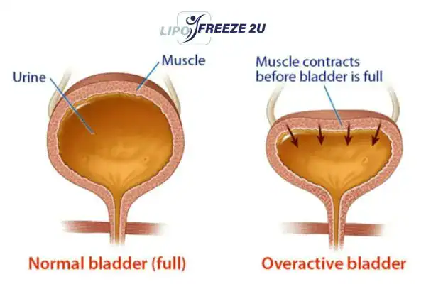 diagram of overactive bladder treatment Lincolnshire