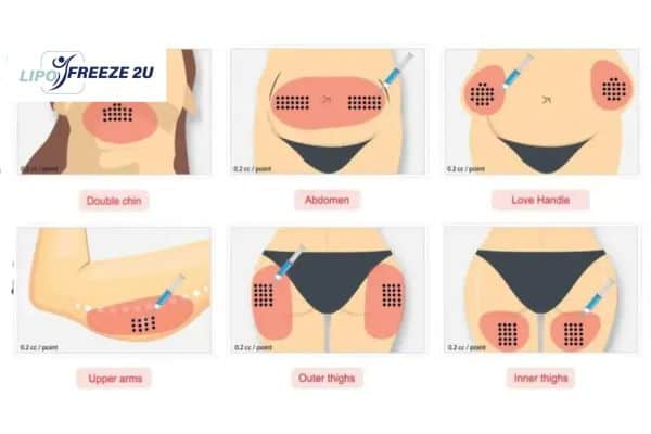 Benefits of Choosing Aqualyx for Fat Reduction Lincolnshire