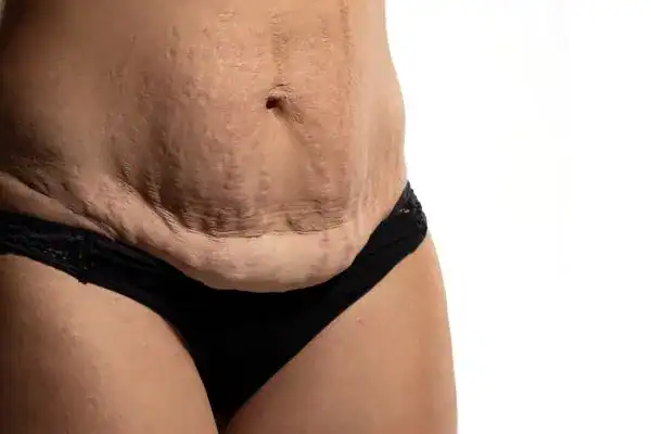 loose skin after weight loss injections Lincolnshire