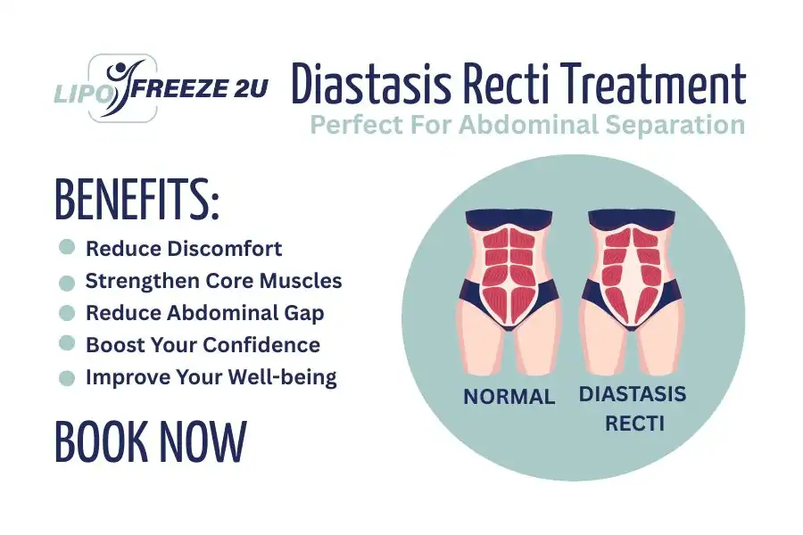 Benefits of body toning treatment Lincolnshire for Diastasis recti