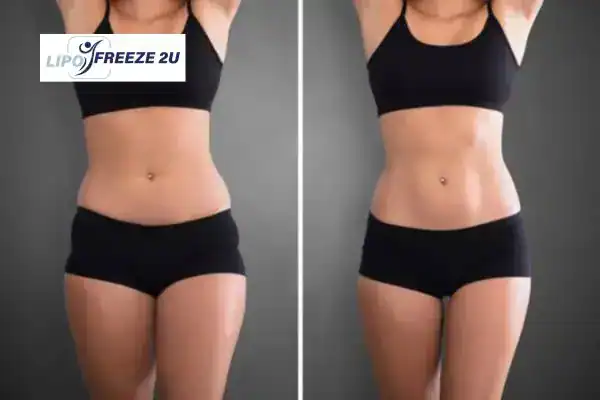 How Can LIPO FREEZE 2U Support Your Post-Pregnancy Body Recovery Lincolnshire?