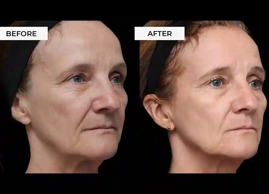 How Many RF Microneedling Sessions Will You Need to See a Difference Lincolnshire?