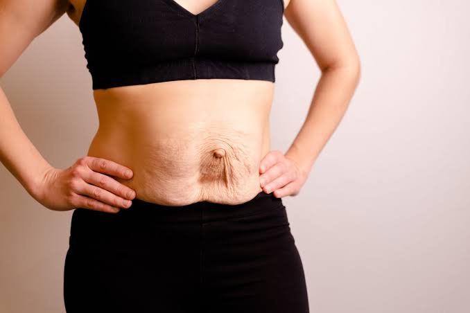 Is Surgery Really the Only Way to Repair Diastasis Recti Lincolnshire?