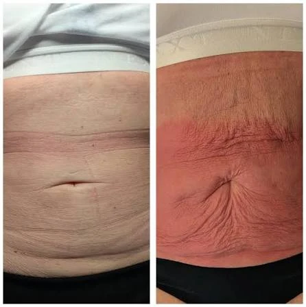 How Does RF Microneedling Improve Crepey, Thin and Uneven Skin Texture Lincolnshire?