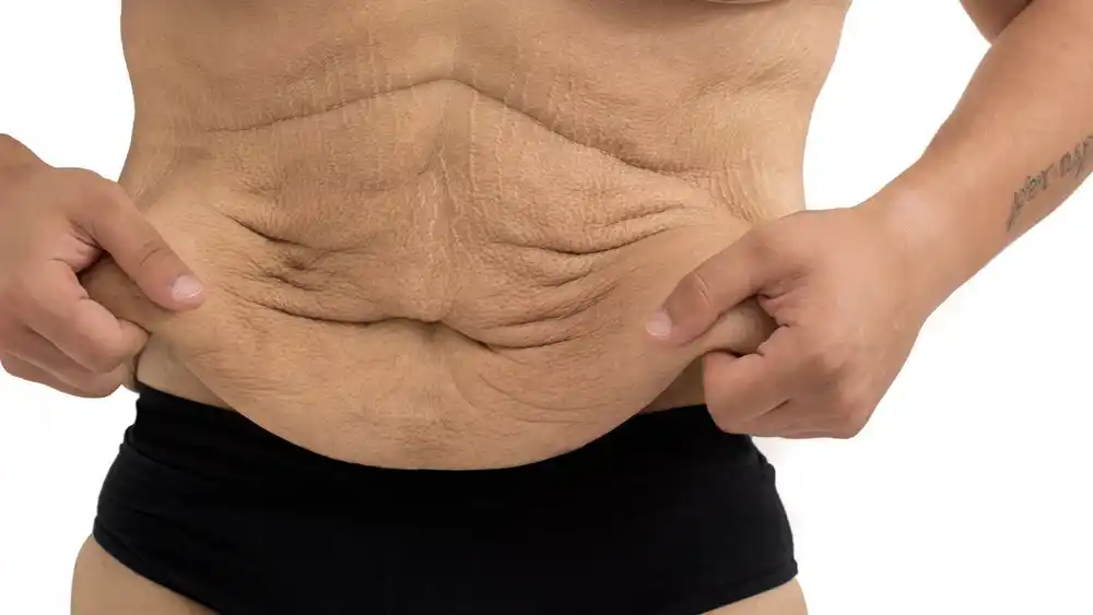 RF Microneedling for Loose Skin: How Can It Help Tighten and Reshape the Skin Lincolnshire?